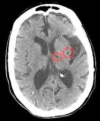 treatment of a lacunar infarct